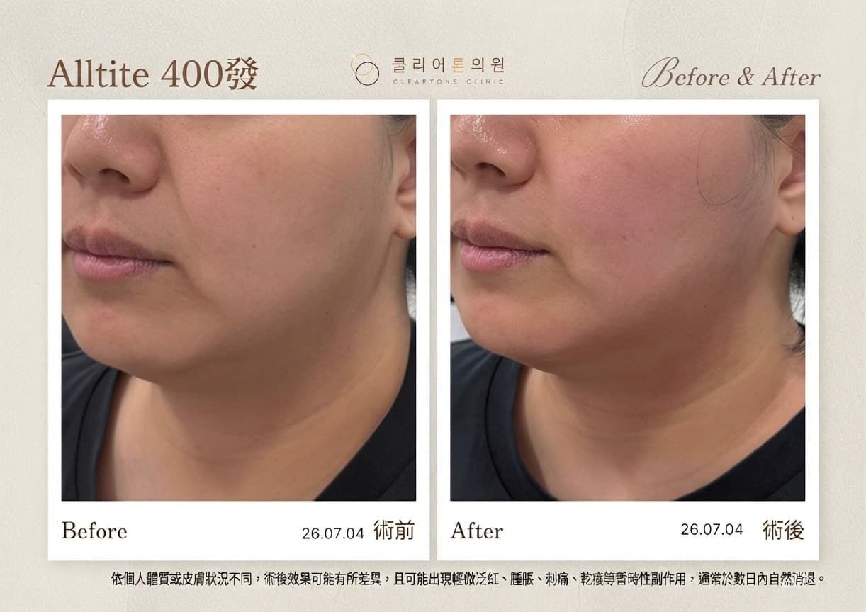 Alltite拉提治療前後對比